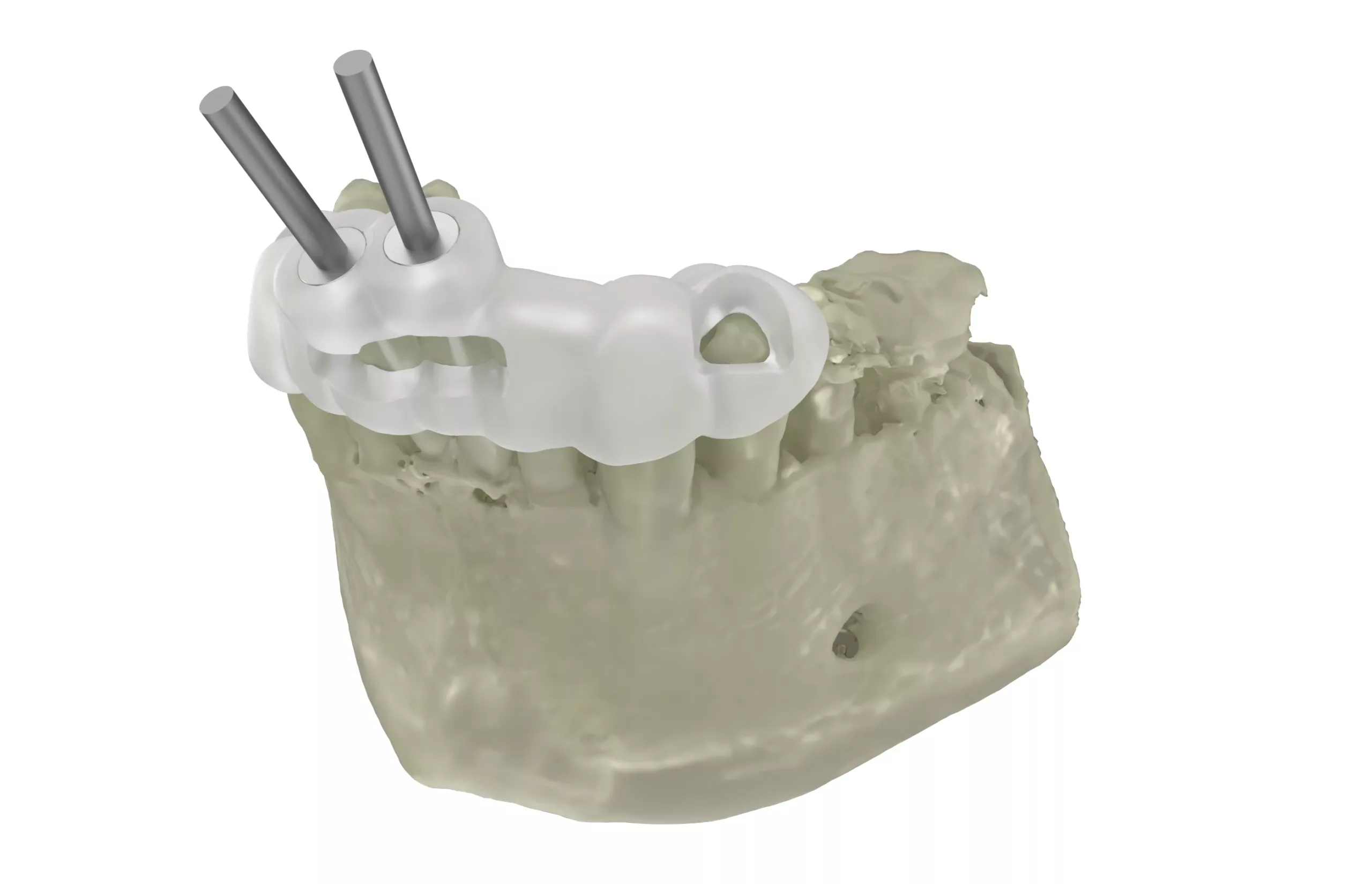 Endodontieschablone.