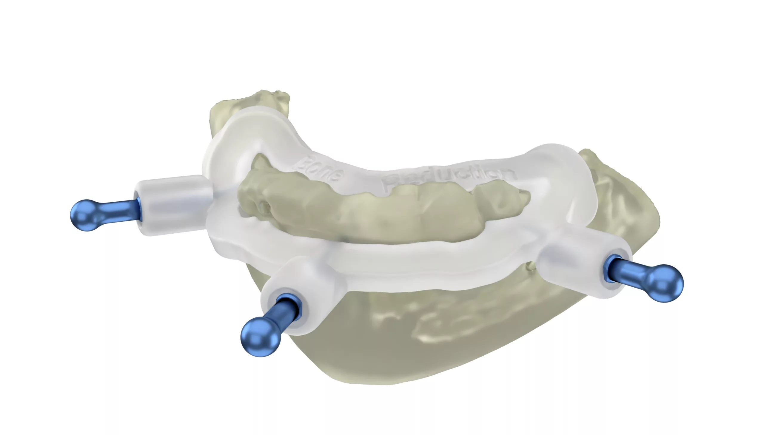 Beispiel einer Knochenreduktionsschablone.