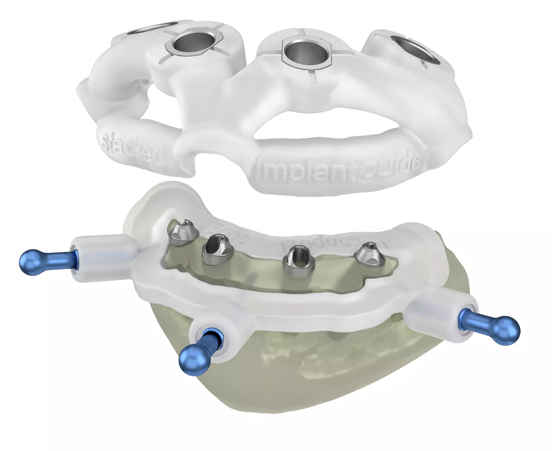 Knochenreduktionsschablone mit Implantationsschablone.