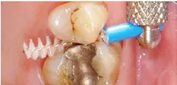 Abb. 5 d, e) Vom Patienten eingesetzte Interdentalraumbürste mit für diese Situation zu geringer Reichweite. Sie ließ sich ohne Widerstand durch den Interdentalraum führen und verblieb nach der Passage weitgehend plaquefrei. Damit vermittelte sie dem Patienten einen falschen Eindruck von „Sauberkeit“.
