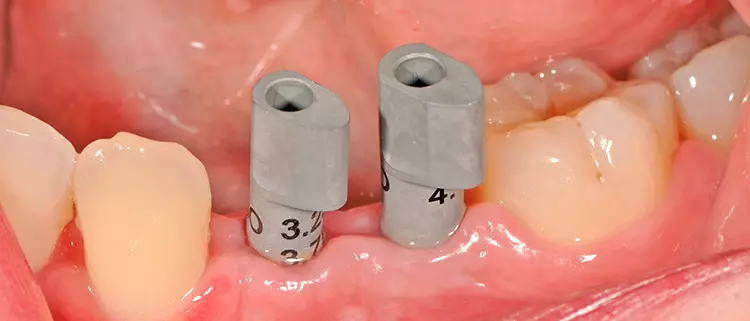 Scan-Bodies in regio 34 und 35 definieren die Implantatposition für die digitale Intraoral-Abformung.