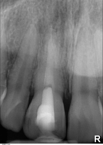 Abb. 2: 9 Tage später wurde eine Wurzelkanalbehandlung mit Trikalziumsilikat (Biodentine) eingeleitet. Das Bild zeigt 3 Monate nach Wurzelfüllung eine fortschreitende Resorption im mittleren Wurzeldrittel.