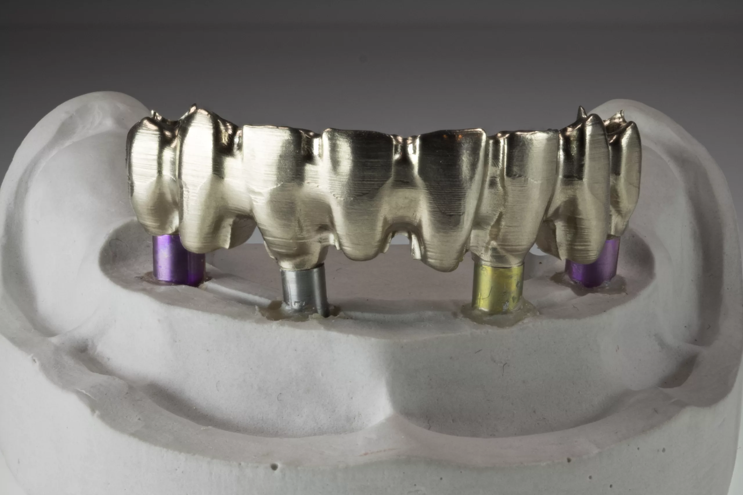 Direkt verschraubte Brücke auf Camlog-Implantaten.