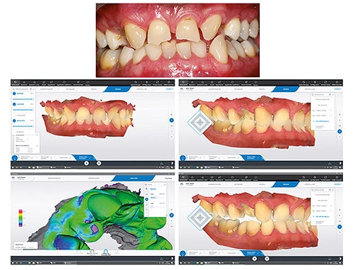 Die CEREC-Applikation OraCheck und das dynamische digitale Modell sind Werkzeuge für die Patientenanalyse. Sie machen Veränderungen sichtbar und geben Hinweise auf Abrasion, Erosion, Materialabplatzung, Schwellung, Rezession, Plaque und veränderte Zahnpositionen. Bildsequenz: Ausgangsbefund, Abrasionsverlauf und präpothetische digitale Funktionsanalyse.