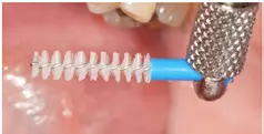 Abb. 5 e) Vom Patienten eingesetzte Interdentalraumbürste mit für diese Situation zu geringer Reichweite. Sie ließ sich ohne Widerstand durch den Interdentalraum führen und verblieb nach der Passage weitgehend plaquefrei. Damit vermittelte sie dem Patienten einen falschen Eindruck von „Sauberkeit“.