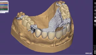 Die Kooperation umfasst die Abstimmung von Datenschnittstellen zwischen der DentalCAD Software und den inLab CAD/CAM Komponenten, dem Scanner Eos X5 und den Laborfertigungseinheiten inLab MC X5 und inLab MC XL.