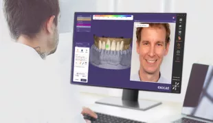 Das Add-on Modul Smile Creator von exocad bietet viele neue Funktionen, darunter mehr Visualisierungsmöglichkeiten (z. B. verbesserte Farbanpassung für realistischere Vorschaubilder) sowie eine neue Vorher-Nachher-Ansicht mit Schieberegler.