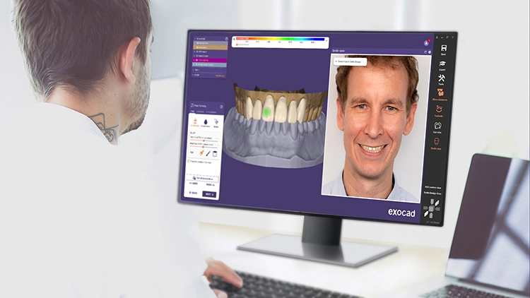 Das Add-on Modul Smile Creator von exocad bietet viele neue Funktionen, darunter mehr Visualisierungsmöglichkeiten (z. B. verbesserte Farbanpassung für realistischere Vorschaubilder) sowie eine neue Vorher-Nachher-Ansicht mit Schieberegler.