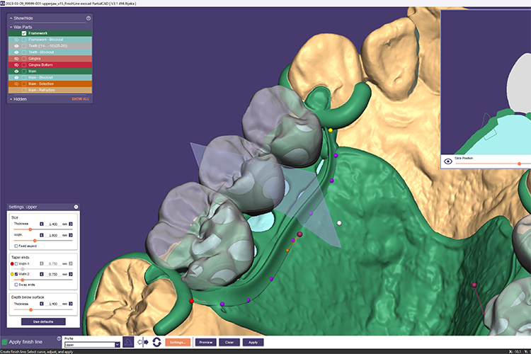 PartialCAD 3.1 Rijeka bietet außerdem eine Funktion zur Rückwärtsplanung sowie die verbesserte Integration mit DentalCAD von exocad.