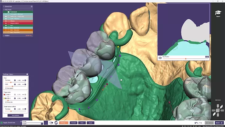 PartialCAD 3.1 Rijeka bietet außerdem eine Funktion zur Rückwärtsplanung sowie die verbesserte Integration mit DentalCAD von exocad.