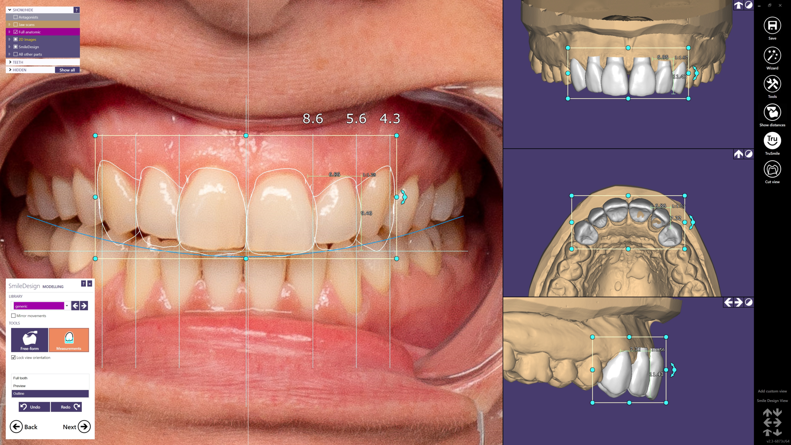 Mit dem neuen Add-on Modul Smile Creator lassen sich hochästhetische Restaurationen einfach, zeitsparend und vorhersagbar durch Kombinieren von Patientenfotos und 3D-Situationen virtuell planen.