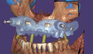 exoplan 3.0 Galway ermöglicht die Planung von Implantaten und das Design von Bohrschablonen für zahnlose Patienten. Die hierfür erforderlichen Tools wie Dual-Scan Protokoll, Platzierung von Verankerungsstiften und Fixierungsschablonen sind ab sofort ve