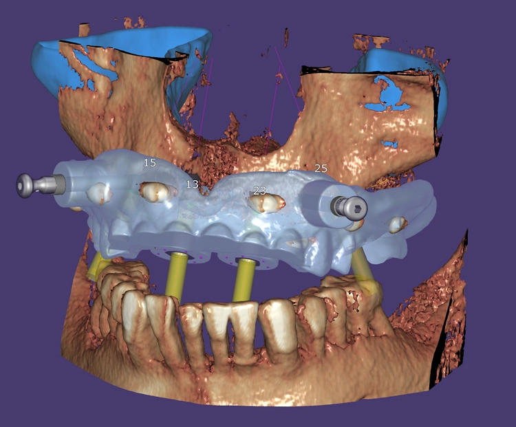 exoplan 3.0 Galway ermöglicht die Planung von Implantaten und das Design von Bohrschablonen für zahnlose Patienten. Die hierfür erforderlichen Tools wie Dual-Scan Protokoll, Platzierung von Verankerungsstiften und Fixierungsschablonen sind ab sofort ve