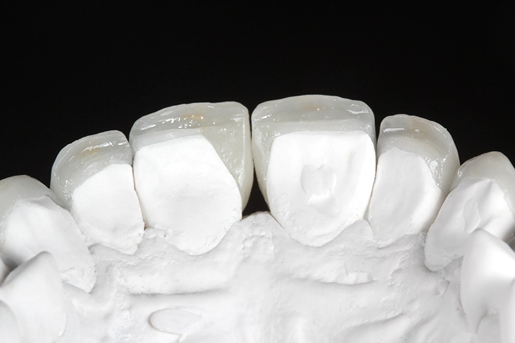 Abb. 8: Die gesamte Oberfläche der Veneers wird mit IPS e.max Ceram Glaze Powder FLUO sowie IPS e.max Ceram Glaze and Stain Liquid allround glasiert. Für die internen Charakterisierungen in Scoop-Technik kommen in diesem Fall IPS Ivocolor Essence-Pulver (E 14 profundo, E 15 ocean, E 02 creme, E 01 white, E 05 copper) zum Einsatz. Die Abbildung zeigt die für eine natürliche Erscheinung palatinal/inzisal platzierten Effekte.