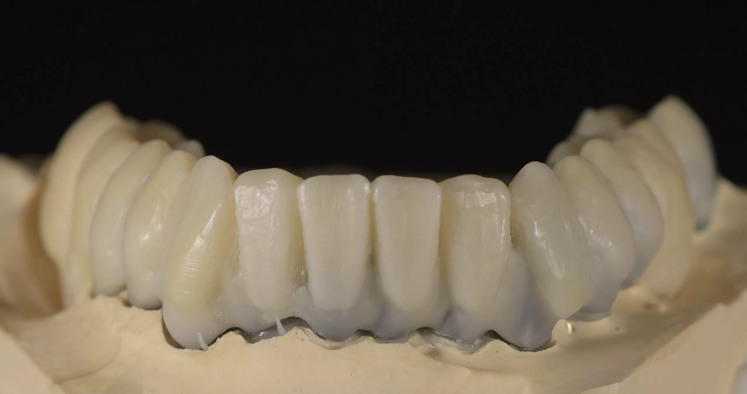 Abb. 11a: Wax-up auf dem Metallgerüst vor dem Einbetten.