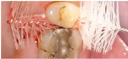 Abb. 5 g, h) Bei Verwendung einer Interdentalraumbürste mit größerer Reichweite ließ sich eine größere Plaquemenge entfernen. Ein Gemisch aus Plaque und Blut (insbesondere um den Drahtkern der Bürste) war deutlich zu erkennen.