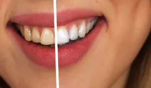 Wenn ein Zahnarzt z.B. für Bleaching mit Preisangaben wirbt, gilt es einiges zu beachten.
© geralt, pixabay
