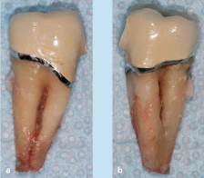 Abb. 11a u. b: ... Extraktion mit Erhalt der Brücke von 44-45-46 im Jahr 2014 trotz wiederholter einschließlich offener Parodontitistherapie an 47 (Ansicht von vestibulär/oral mit schlitzförmiger Furkation).