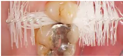 Abb. 5 i, j) Der Patient wurde instruiert, die größere Interdentalraumbürste zu nutzen. Es kam nach kurzer Zeit nicht mehr zur Blutung, und die Bürste erschien nach der Interdentalraumpassage sauber und geruchsfrei.