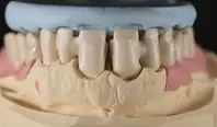 Abb. 6: Die nach palatinal versetzte Aufstellung. Ein Silikonschlüssel hilft uns dabei, dem erarbeiteten Wax-up treu zu bleiben und das angestrebte Erscheinungsbild zu erreichen.