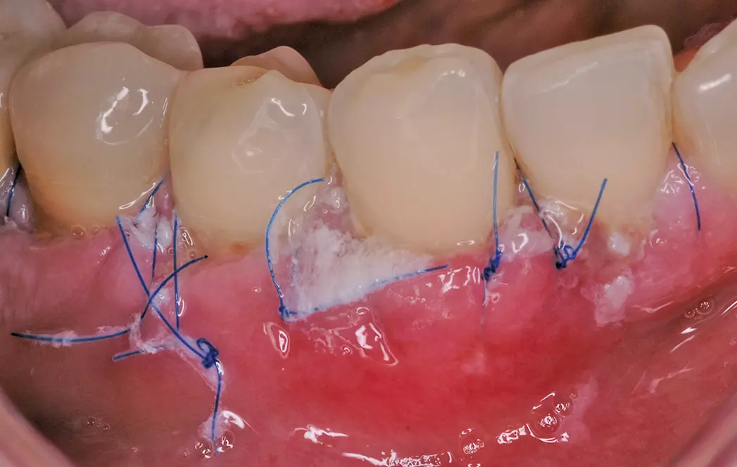 Abb. 8: Zustand am 2. postoperativen Tag.