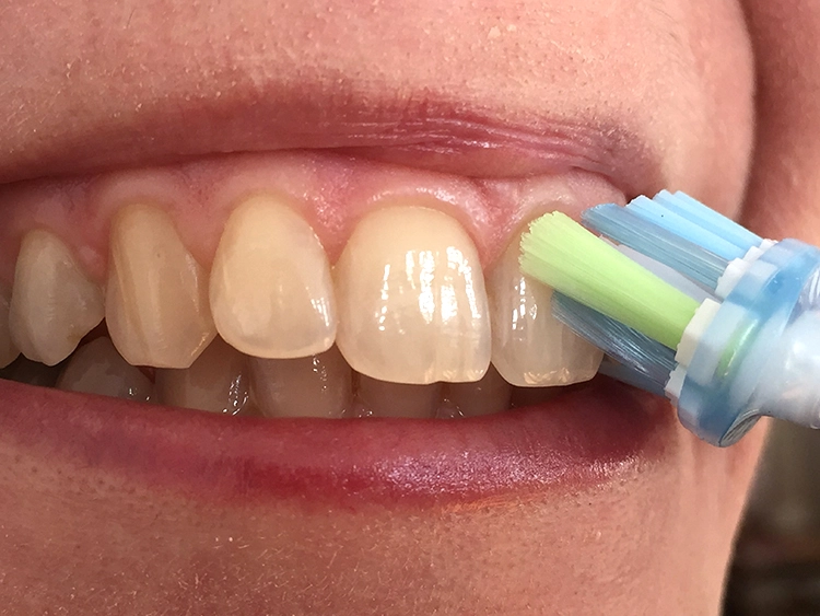 Abb. 1: Schallzahnbürsten entfernen bei korrekter Anwendung signifikant mehr Plaque als Handzahnbürsten. Die hier gezeigte Bürste wird in einem Winkel von ca. 45° zur Gingiva mit wenig Druck in die Interdentalräume geführt, gefolgt von einer Auswischbewegung.