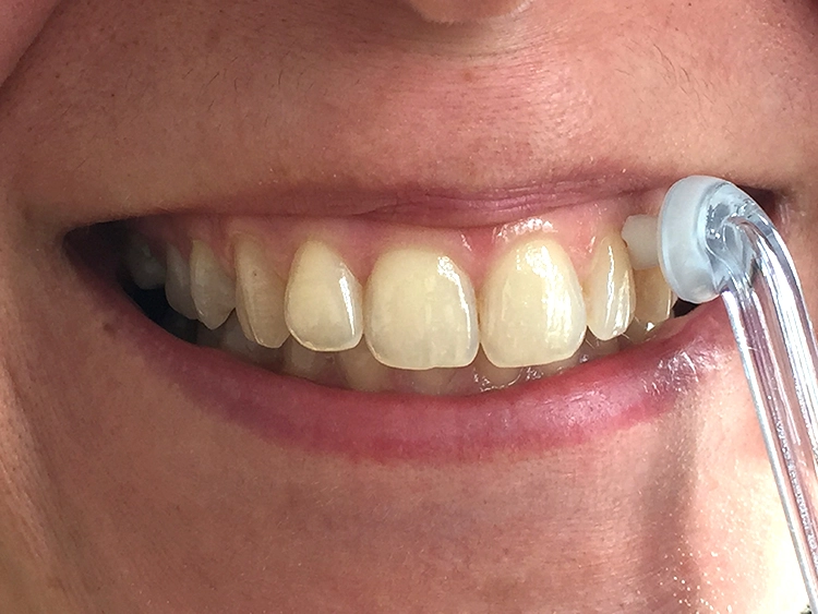 Abb. 2: Mit beschleunigten Mikrotröpfchen lassen sich Interdentalräume auch bei Zeitmangel oder manueller Einschränkung effektiv sauber halten.