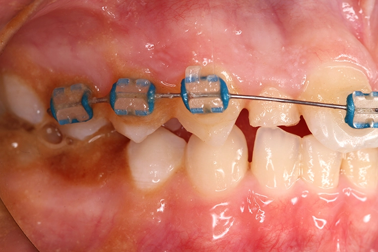 Abb. 3a u. b: Bei Patienten mit Brackets und anderen festsitzenden Apparaturen zeigte sich eine Kombination von Schallzahnbürste und Mikrotröpfchen-Gerät bei der Kontrolle gingivaler Entzündung effektiver als eine Handzahnbürste plus Zahnseide.