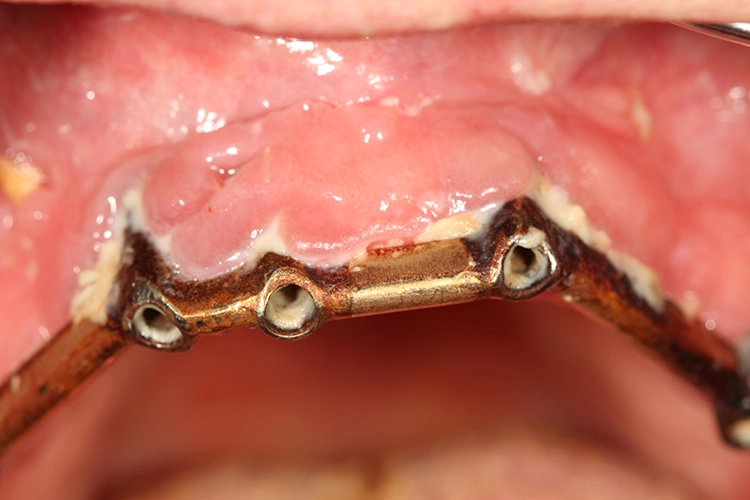 Abb. 4a u. b: Implantatpatienten können mit Schallzahnbürste und Mikrotröpfchen-Gerät auch komplexe prothetische Bauteile effektiv sauber halten. Im gezeigten Beispiel erfolgte zunächst eine professionelle Zahnreinigung.