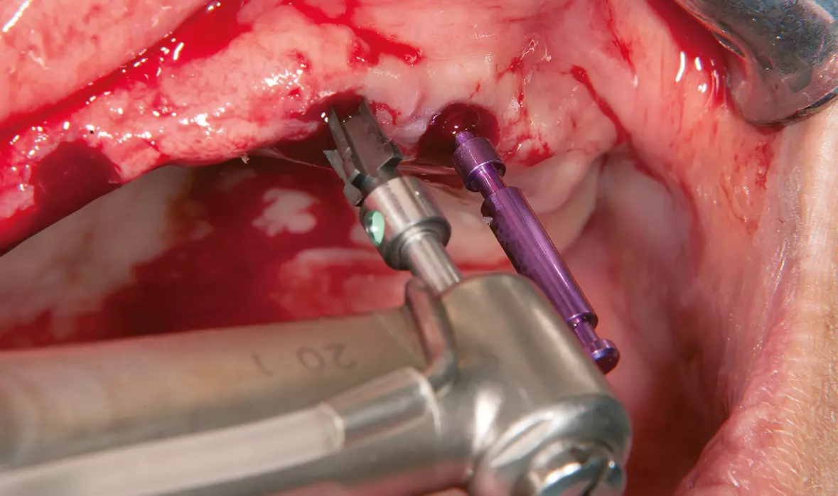 Abb. 12: Mit dem Extensions Drill wird die Implantatalveole auf die richtige Größe gebracht.