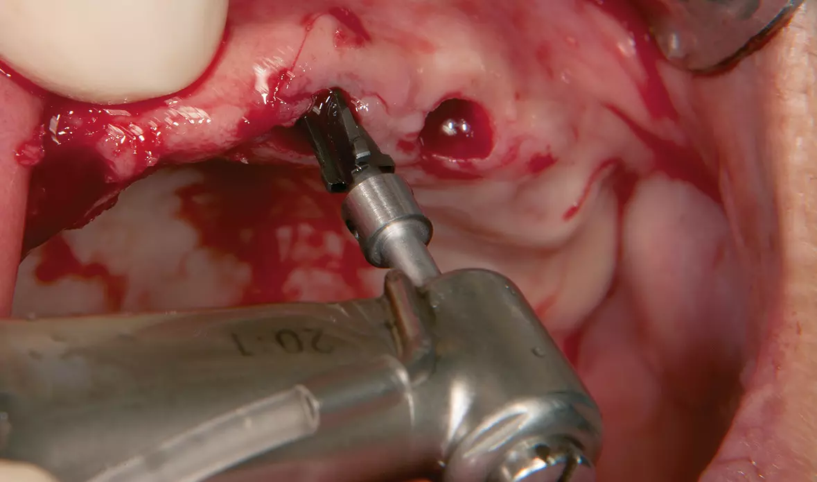 Abb. 13: Vorbereiten weiterer Implantatalveolen.