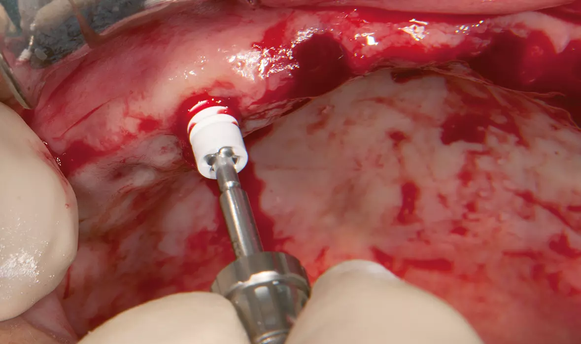 Abb. 16: Manuelles Eindrehen des Implantates.