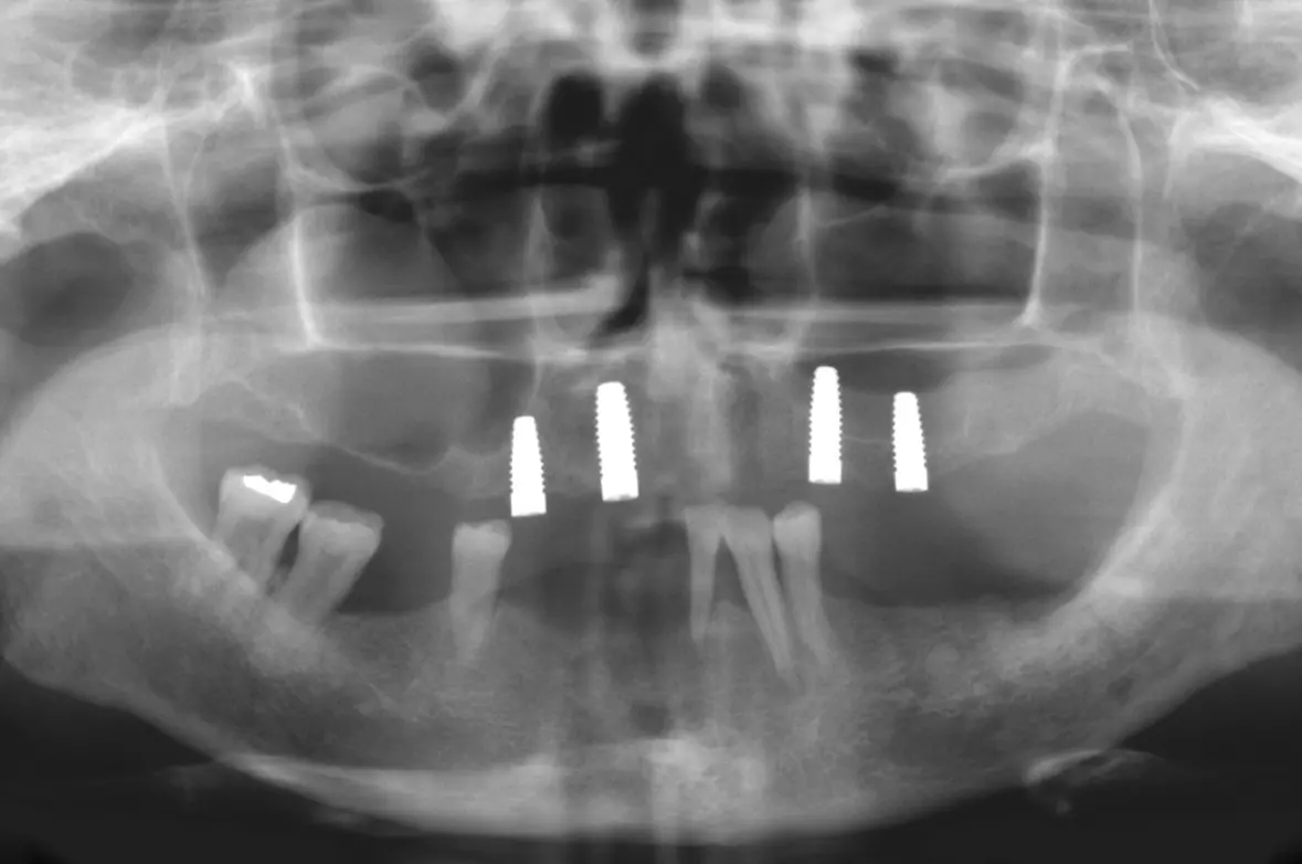 Abb. 2: Nach Implantation im Oberkiefer.