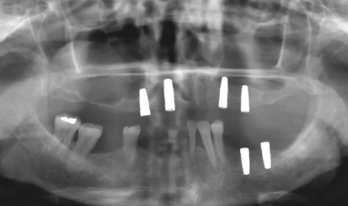 Abb. 3: Nach Implantation im Unterkiefer.
