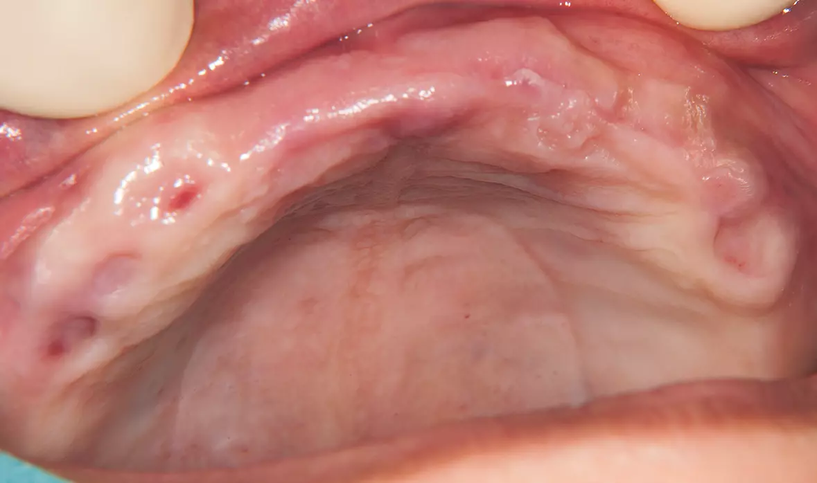Abb. 4: Oberkiefer vor Implantatinsertion.