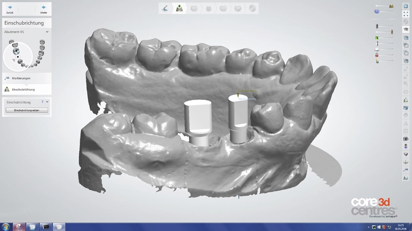 Abb. 2: Digitale Intraoralabformung der Implantatposition, Ausgangspunkt mit Messdaten für die Konstruktion von Abutment und Krone.