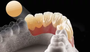 Durch den schichtweisen Aufbau der verschiedenen Farben des Multilayer-Zirkons ist ein sehr natürliches Endergebnis mit hoher Transluzenz im inzisalen Drittel des Zahnes möglich.
