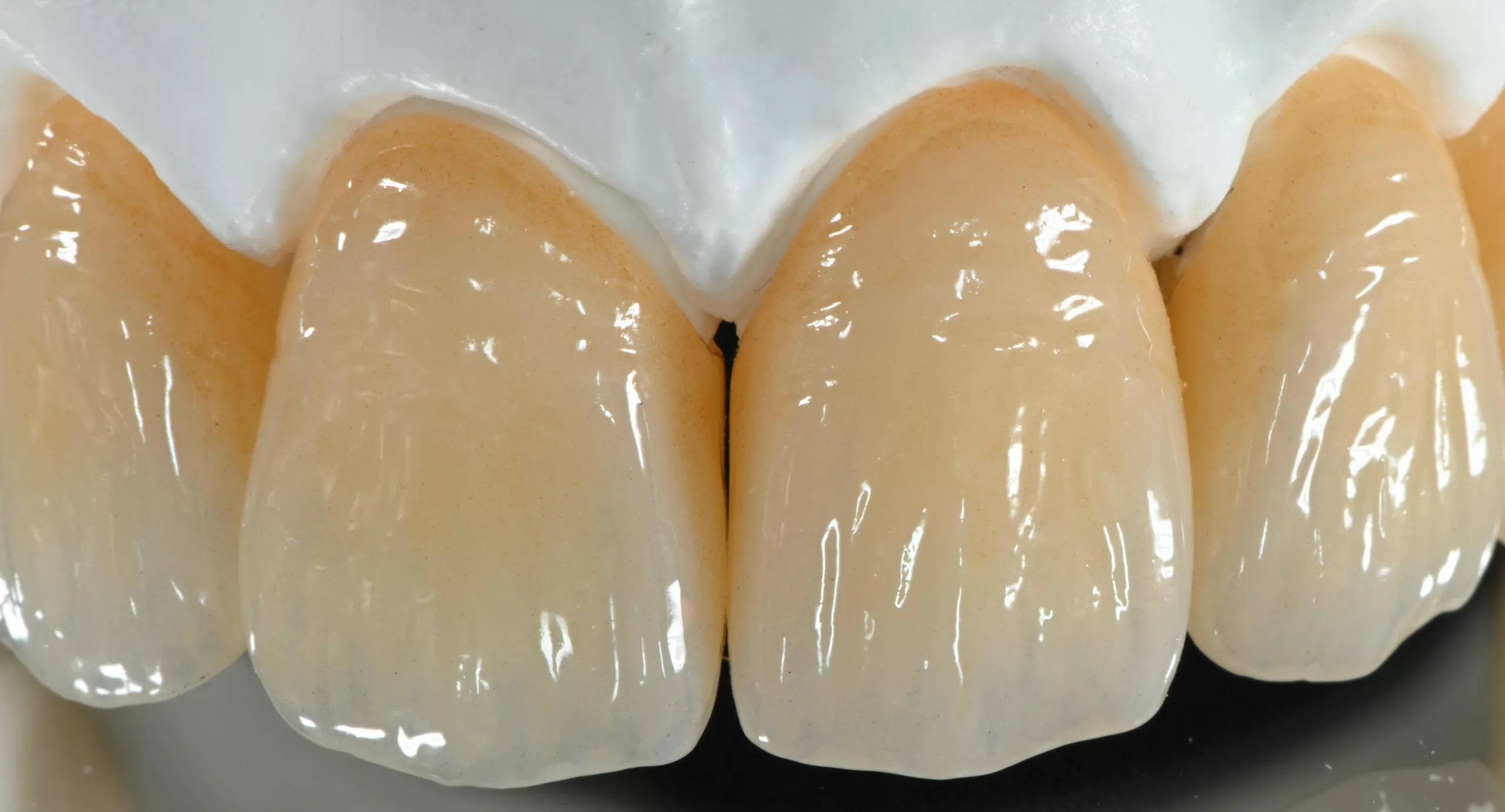 Monolithischen Restauration aus 3D Pro Zir gefertigt und mit dem 3D-Farbsystem Biomic Shade/Glaze individualisiert.