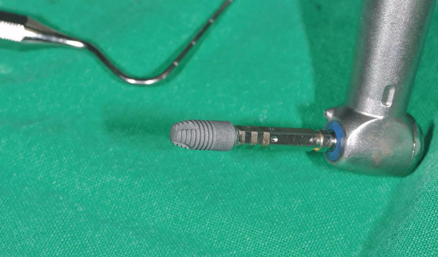 Abb. 13: Das Astra Tech Implant System EV 4,2 S (Dentsply Sirona).