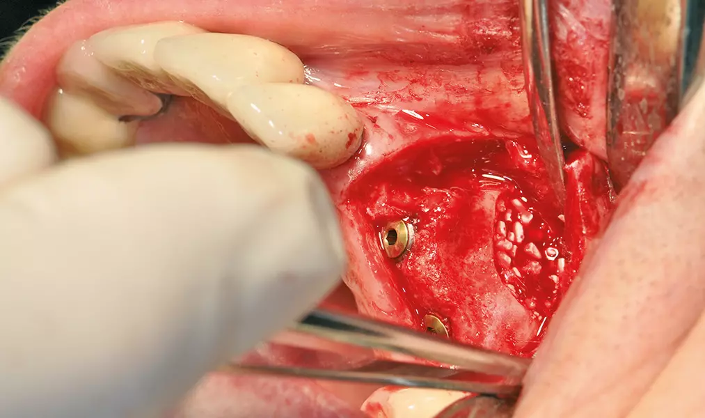 Abb. 14: Unter Sicht im augmentierten Bereich inserierte Implantate.