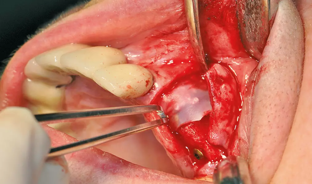 Abb. 20: Reponieren der periimplantären Mukosa.