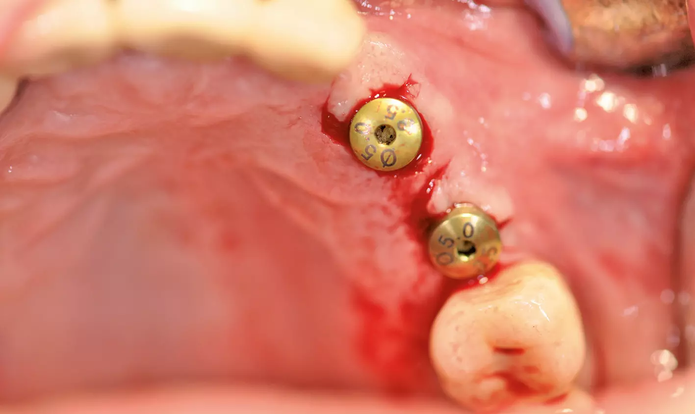 Abb. 22: Implantatverschluss mit Gingivaformern bis zur Fertigstellung des Provisoriums.