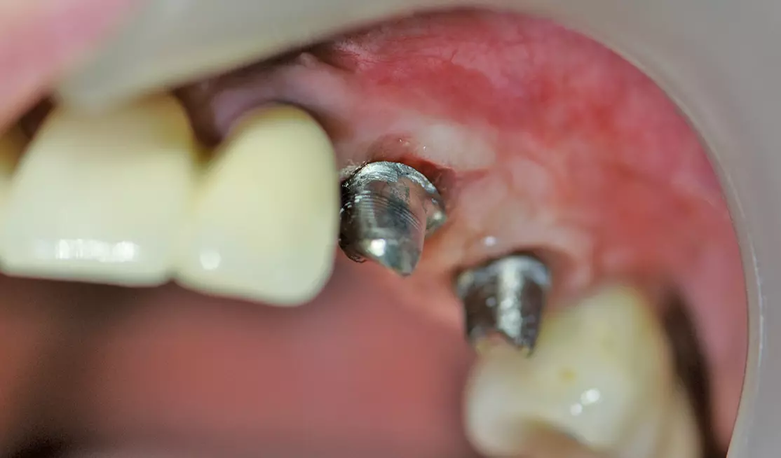 Abb. 24: Individuelle CAD/CAM Atlantis Abutments aus Titan.