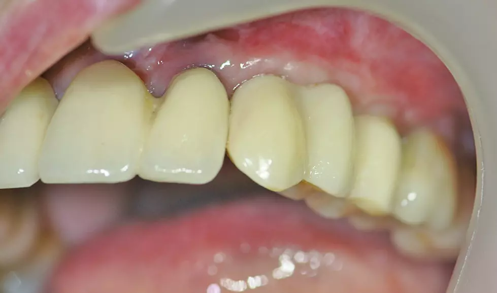 Abb. 25: Das therapeutische Provisorium unmittelbar nach dem Eingliedern.