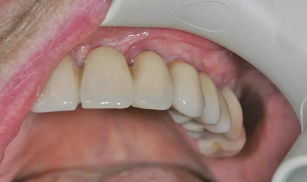Abb. 26: Finale Restauration.