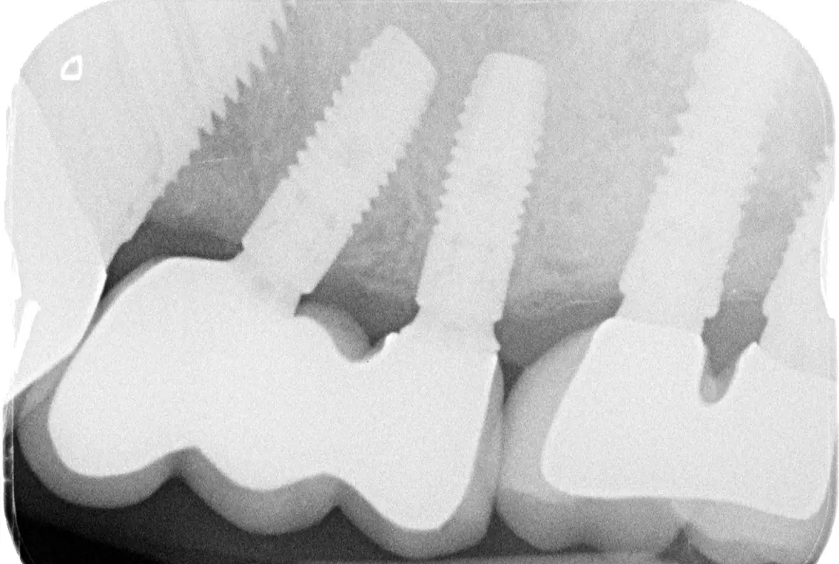 Abb. 27: Röntgenkontrollaufnahme nach Eingliederung der finalen Arbeit.