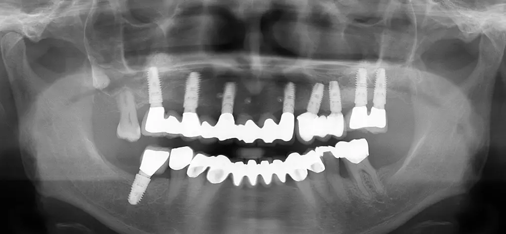 Abb. 28: Röntgenkontrollaufnahme, Implantatbrücke von okklusal und klinische Situation 2 1/2 Jahre nach Augmentation und Implantation.