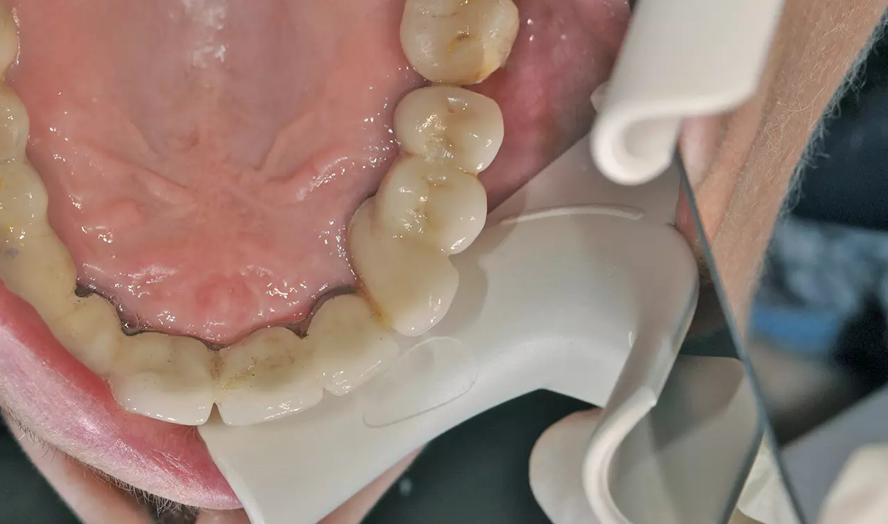 Abb. 29: Röntgenkontrollaufnahme, Implantatbrücke von okklusal und klinische Situation 2 1/2 Jahre nach Augmentation und Implantation.