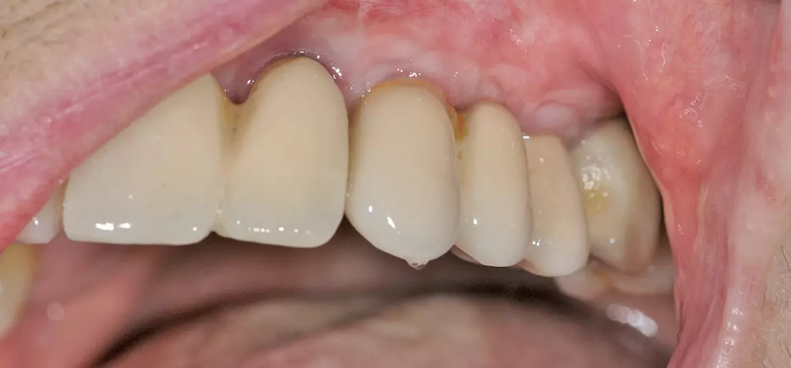 Abb. 30: Röntgenkontrollaufnahme, Implantatbrücke von okklusal und klinische Situation 2 1/2 Jahre nach Augmentation und Implantation.