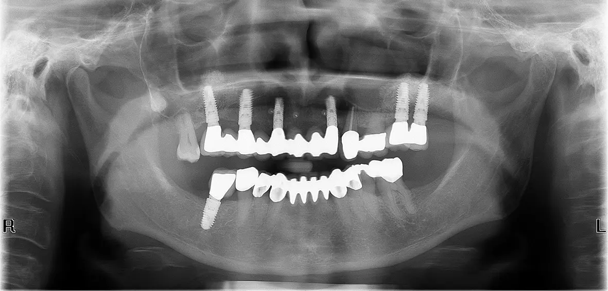 Abb. 5: Ausgangssituation mit austherapiertem Zahn 23.